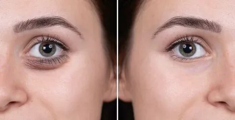 Under-Eye Rejuvenation