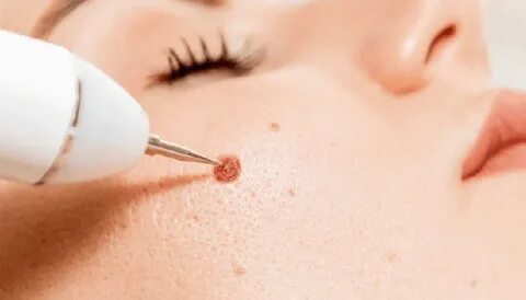 Birthmark Removal