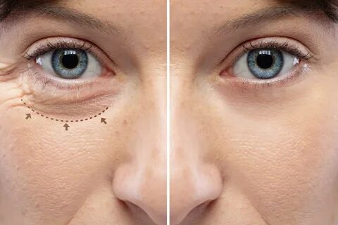 Blepharoplasty (Eyelid Surgery)