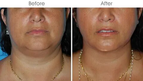Buccal Fat Removal