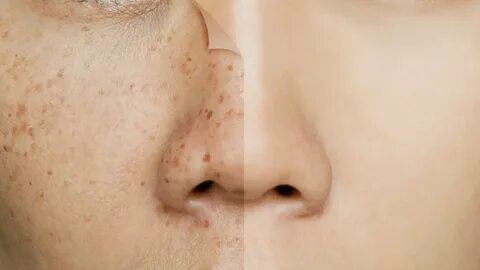 Carbon Laser Peel