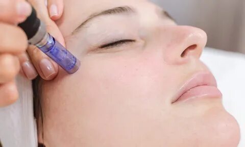 Chemical Peels for Pigmentation & Glow