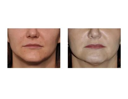 Chin Implant / Chin Reduction