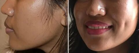 Dimple Creation