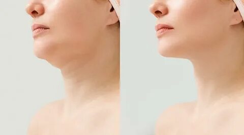 Double Chin Liposuction