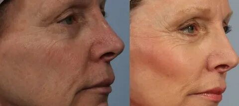 Facial Fat Grafting
