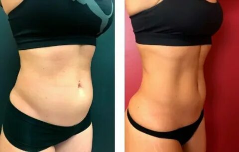 Fat-Dissolving Injections (Lipolytic)