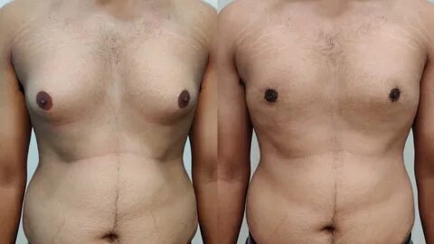 Gynecomastia Correction (Male Chest)