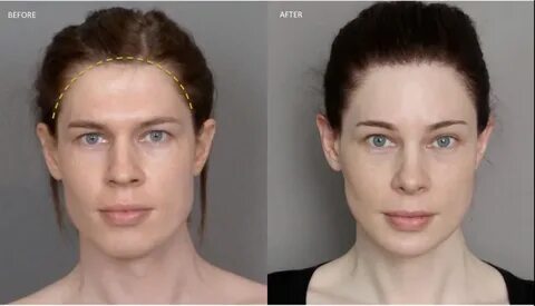 Hairline Redesign for Men & Women