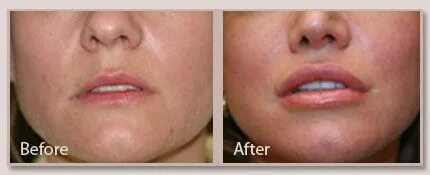 Lip Lift / Lip Reshaping