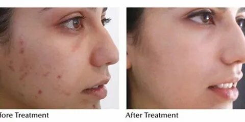 Acne & Post-Acne Scar Treatment