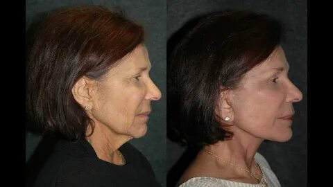 Mini Facelift under Local Anesthesia