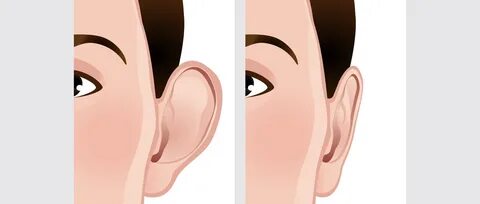 Otoplasty (Ear Pinning)