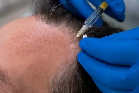 PRP Therapy for Hair Fall