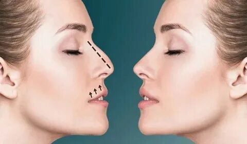 Rhinoplasty (Nose Reshaping)