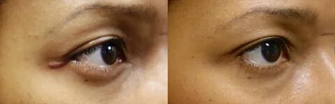 Scar Revision Surgery