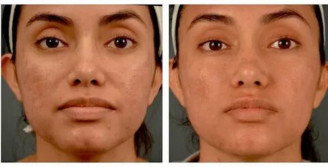 Melasma & Hyperpigmentation Management
