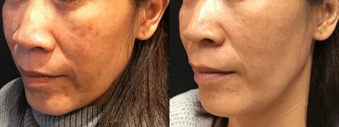 Q-Switch Laser Therapy (Melasma & Pigmentation)