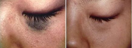 Skin Tag & Mole Removal