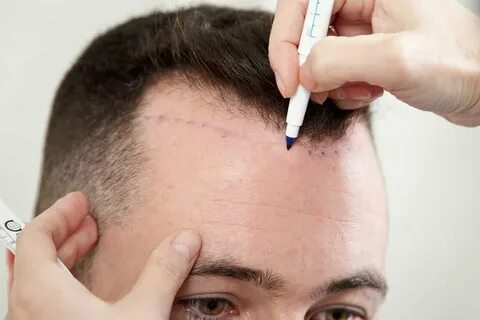 Hair Transplant Surgery