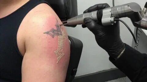 Tattoo Removal (Laser)